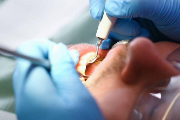 Best Emergency Tooth Extraction in Feather Sound, FL