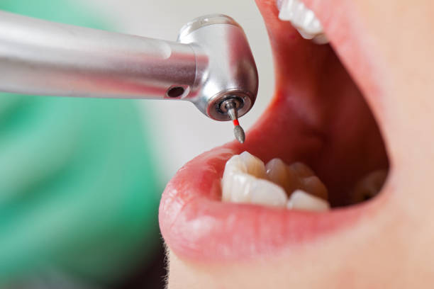 Best Emergency Dental Care for Broken or Chipped Teeth in Feather Sound, FL